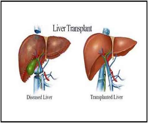 Commonly asked questions for a Liver transplant surgery.