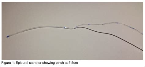 Epidural Catheter Placement