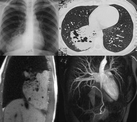 Lung Mass Ct Chest Review