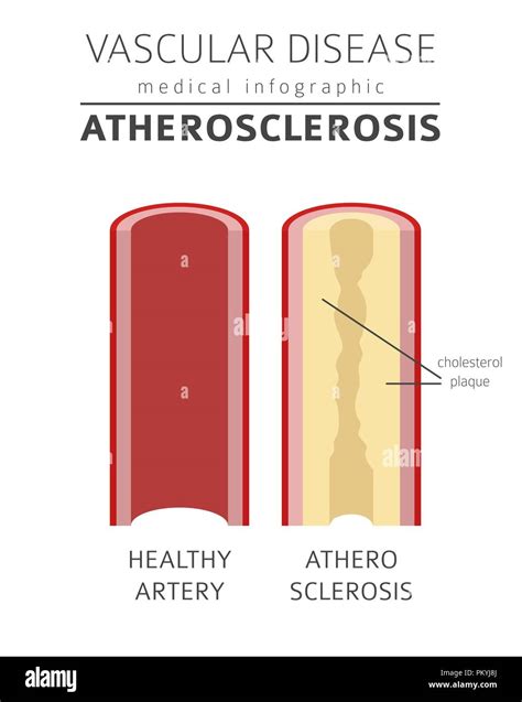 Vascular Diseases Atherosclerosis Symptoms Treatment Icon Set