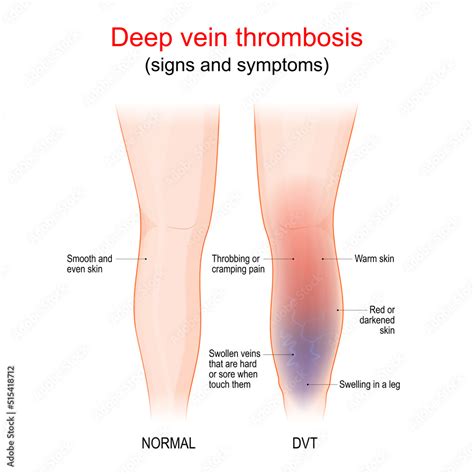 Deep Vein Thrombosis Healthy Leg And Leg With Dvt Sign And Symptoms Stock Vector Adobe Stock