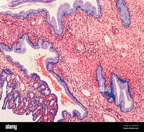 Nasal Polyp Light Micrograph LM Of A Section Through A Nasal Polyp