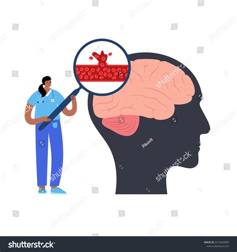 Hemorrhagic Brain Stroke Concept Apoplexy Cerebral Stock Vector Royalty Free 2013920903