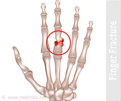 Xray Broken Finger