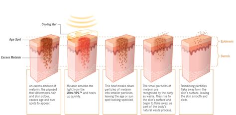 Ipl Skin Laser Intellihealth Plus Rejuvenation Clinic