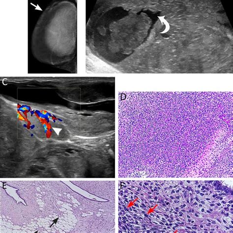 Bilateral Borderline Phyllodes Tumor A Year Old Woman Presented