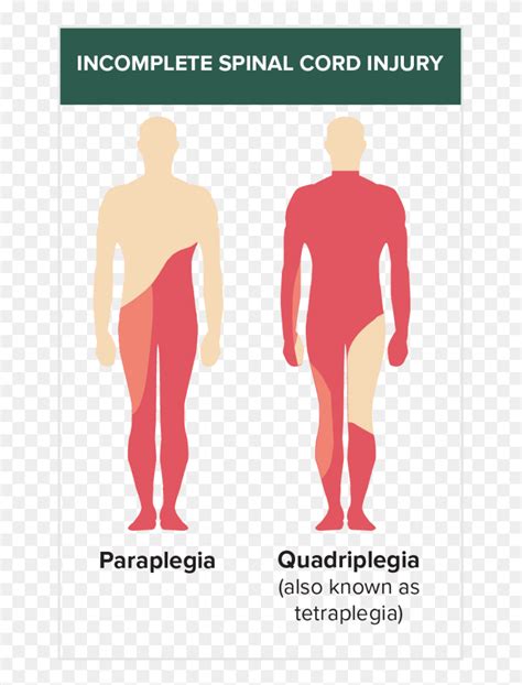 Incomplete Spinal Injury - Incomplete Injury Of Spinal Cord, HD Png ...