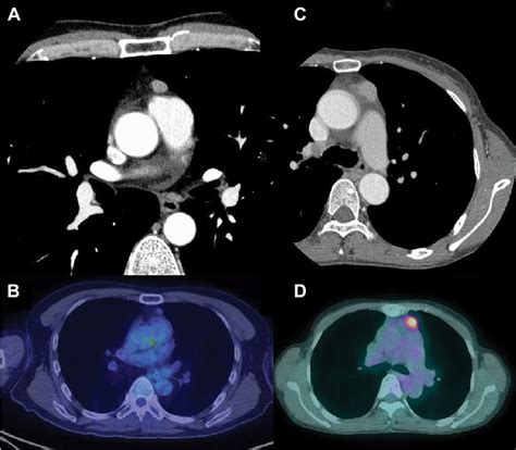 Ct And Pet Ct Findings Of Patients With Type Ab Thymoma And Thymic