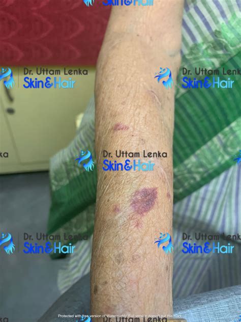 Gallery Advanced Diagnosis And Treatment Dr Uttam Lenkas Skin