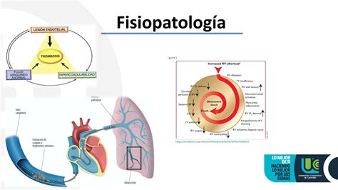 Tromboembolismo Pulmonar Youtube