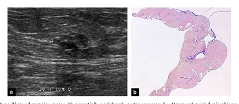 Pdf Complex Cystic Breast Masses In Ultrasound Examination Semantic