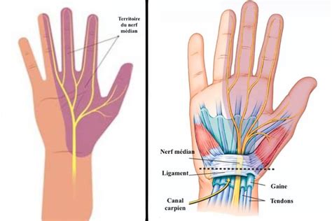 Symptômes et Traitements du Canal Carpien