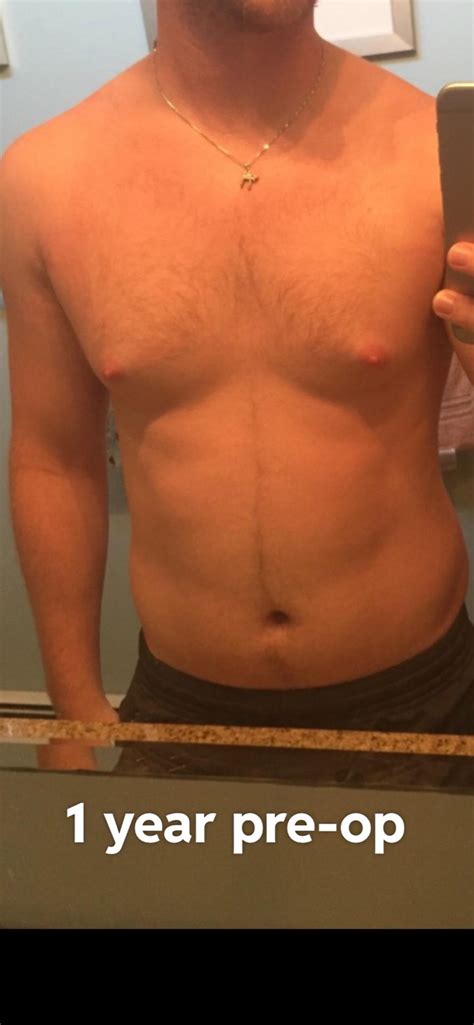 Pre Op And Post Op Pics Concerned Rgynecomastia