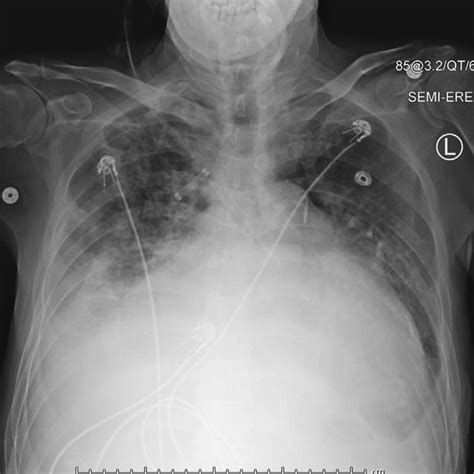 Ap Chest Radiograph Anteroposterior Chest X Ray Revealing Alveolar And