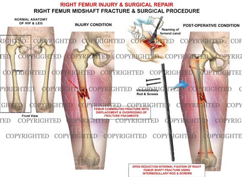 Right femur injury & surgery – Medical Art Works