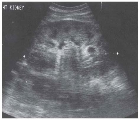 Glomerulonephritis Ultrasound