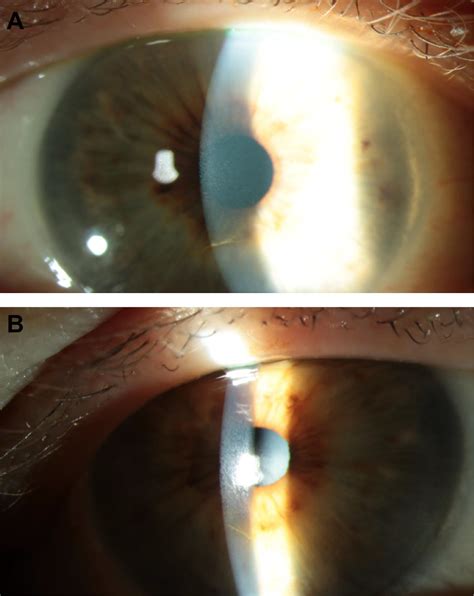 Ribociclib Associated Vortex Keratopathy Canadian Journal Of