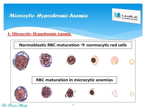 PPT - Laboratory diagnosis of Anemia PowerPoint Presentation, free download - ID:2516406