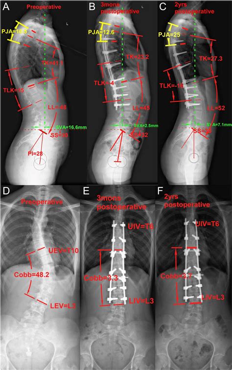 The Pre And Postoperative Radiographs Of A 15 Year Old Female Patient Download Scientific