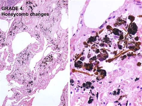 Asbestos Related Lung Disease Surgical Pathology Clinics