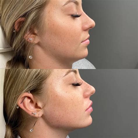 Jawline Filler Injections It S A Secret Med Spa