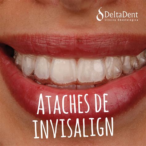 Ataches de invisalign Qué son y para qué sirven