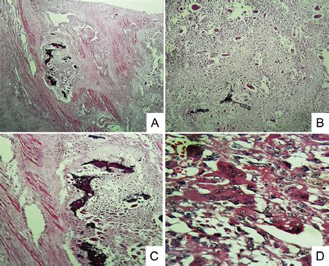 A Rare Case Of A Metastatic Giant Cellrich Osteosarcoma Of The