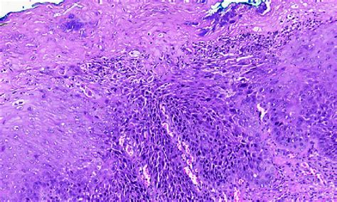 Detail of Figure 4 with focal high-grade epithelial dysplasia (×10).... | Download Scientific ...