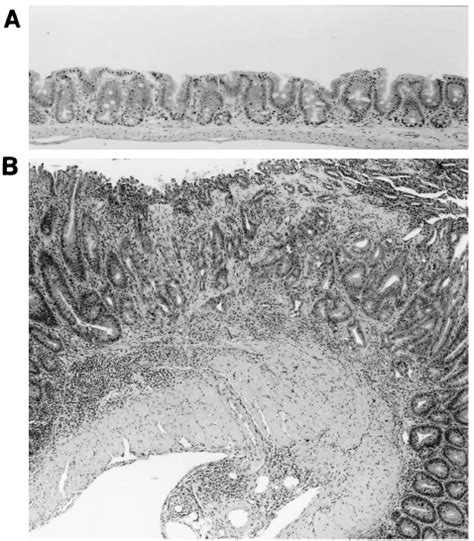 Diffuse And Focal Epithelial Hyperplasia With Marked Inflammation In