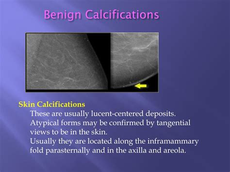 PPT Breast Calcifications Differential Diagnosis And BIRADS