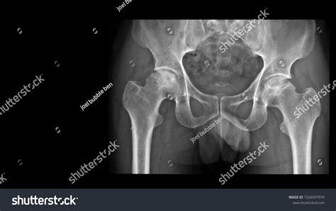 360 Femoral Head Stock Photos, Images & Photography | Shutterstock