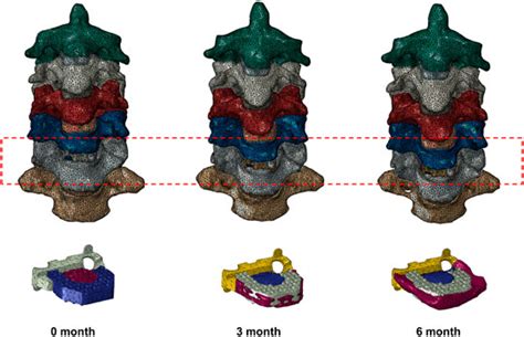 Frontiers Biomechanical Evaluation Of Intervertebral Fusion Process