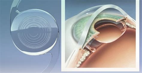 O Que A Lente Intraocular Utilizada Na Cirurgia De Catarata Lucas