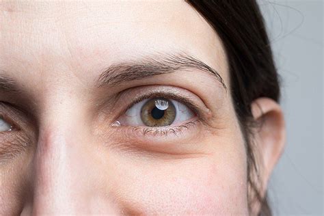 Eye Bags: Understanding the Causes and Treating Them – Cambridge Medical Group