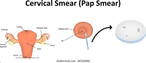 Cervical Smear Pap Smear Stock Illustration 307220582 | Shutterstock