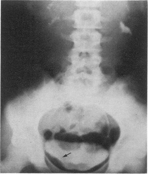 Intravenous Pyelogram Arrow Shows A Filling Defect On The Right