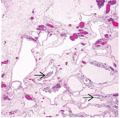 Lymphangioma And Lymphangiomatosis Basicmedical Key