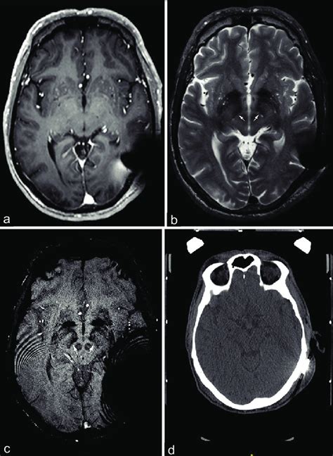 MRI and CT images of patient with cochlear implant after magnet removal ...