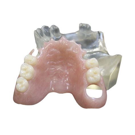 Dentadura postiza sin paladar Descripción ventajas y características