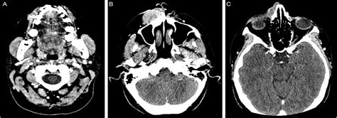 Scielo Brasil Invasive Clear Cell Variant Of Squamous Cell