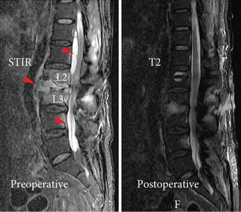 Percutaneous Screw Fixation With Transforaminal Debridement And Vacuum