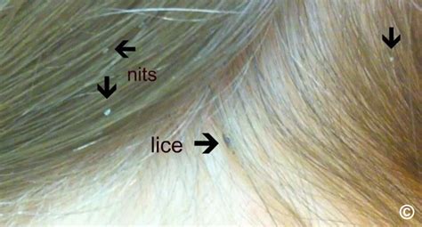 Head Lice Nits