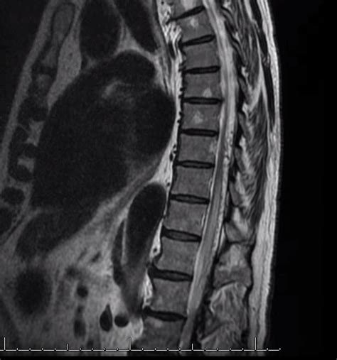 Spinal Dural Fistula Dangerous Anastomosis Adjacent Level Artery of Adamkiewicz | neuroangio.org