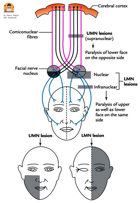 Facial Nerve Paralysis - Dr. Rahul Bagla ENT Textbook