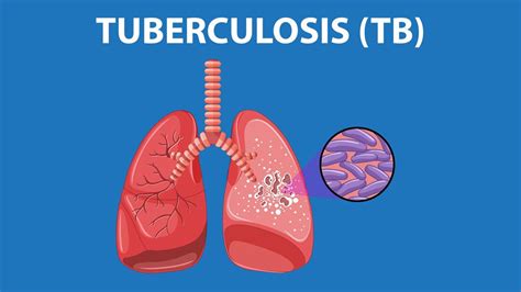 Tuberculosis Here Are Some Of Its Types You Must Know Onlymyhealth