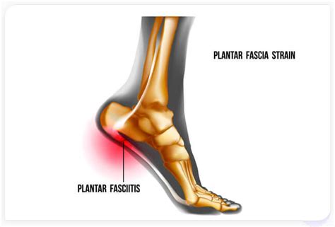 Regenerative Treatment For Plantar Fasciitis Solana Beach Ca