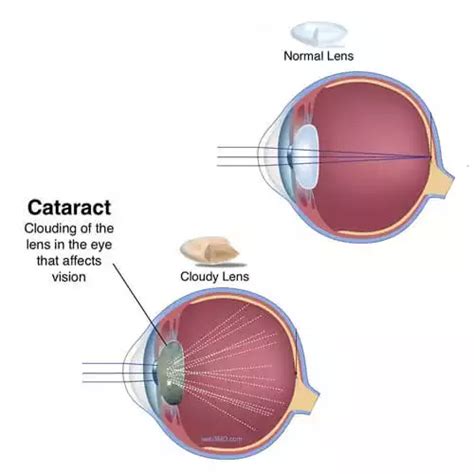 What Is Cataract Surgery Risks Recovery Costs Theamberpost