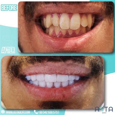 Best Turkish Veneers Veneers In Turkey At Best Price