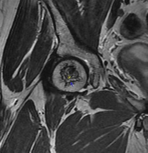 Magnetic Resonance Imaging Of Avascular Necrosis Of The Off