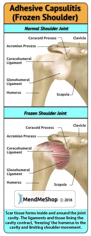 How Long Shoulder Sprain To Heal Robert Lopez Kapsels